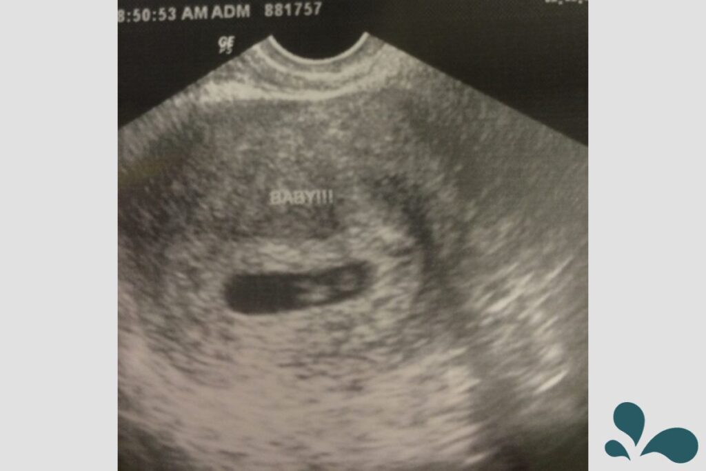 An ultrasound image showing the early development of a fetus with the annotation 'BABY!!!' indicating the excitement of expecting parents.