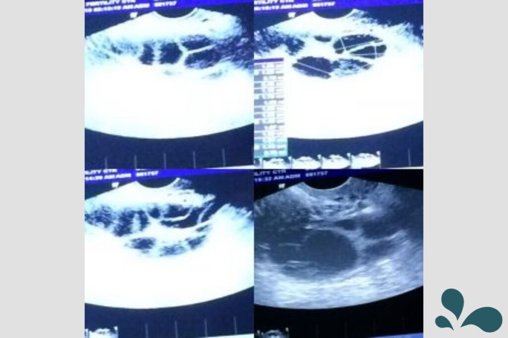 Ultrasound images depicting various stages of egg retrieval process, showcasing the medical technology used in fertility treatments.