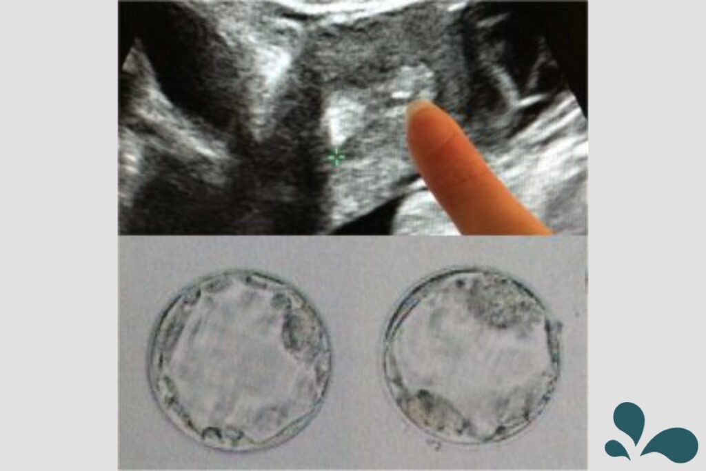 A finger pointing to two embryos on a screen during a medical examination, symbolizing the early stages of life in fertility treatments.