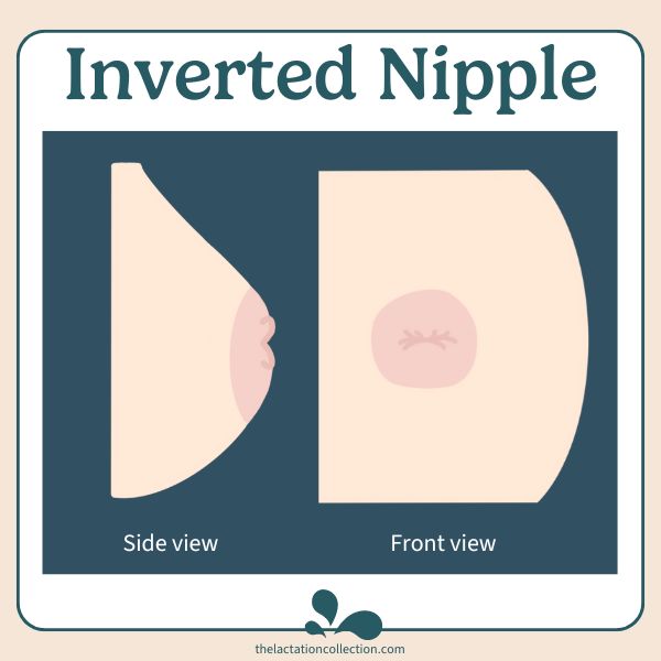 Inverted nipple front and side view