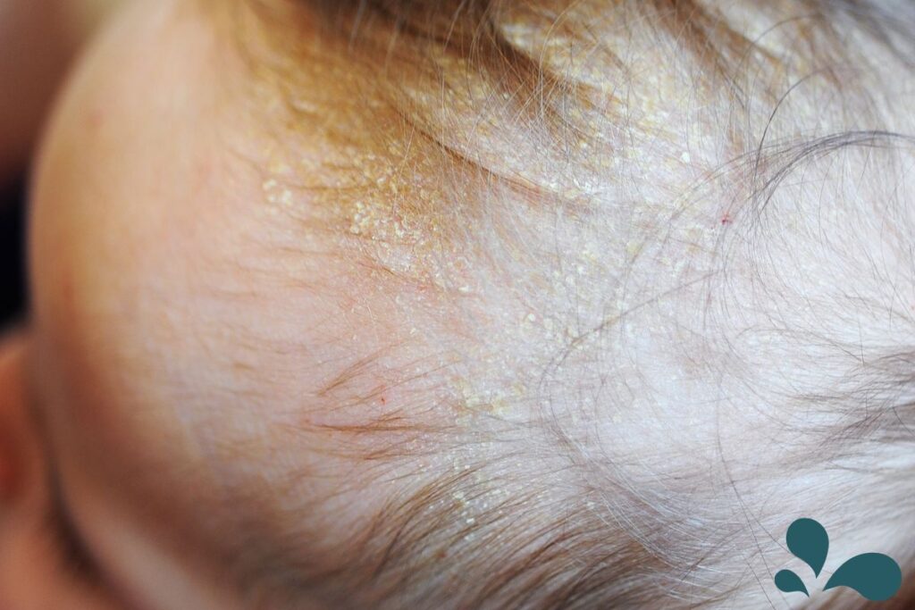 A baby's scalp with cradle cap