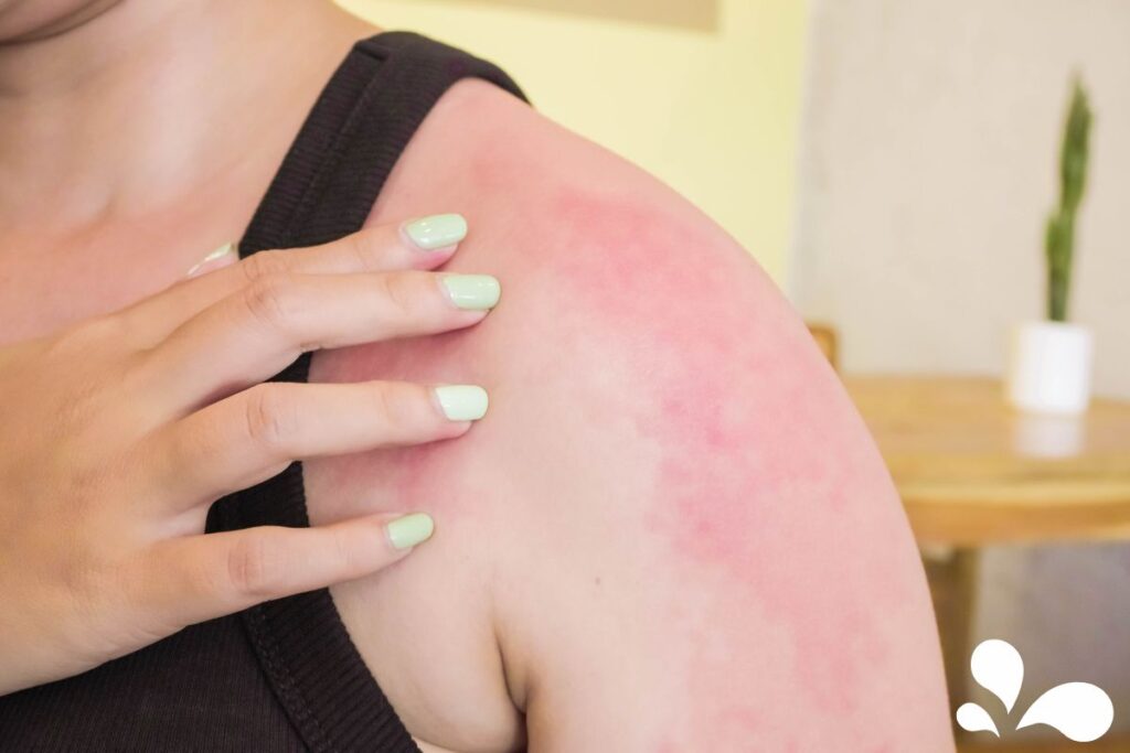 A picture of a woman with sunburn on her shoulder
