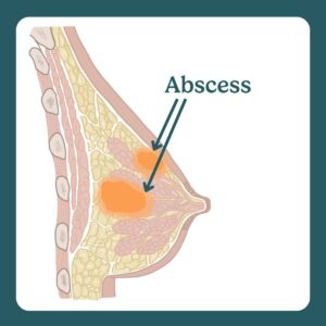 abscess