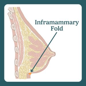 inframammary fold