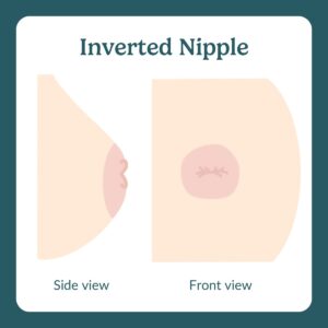 inverted nipple