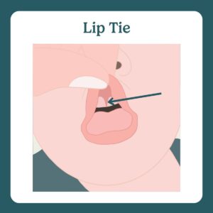 lip tie