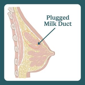 plugged milk ducts