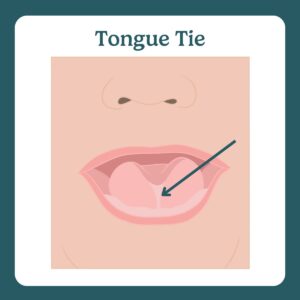 tongue tie